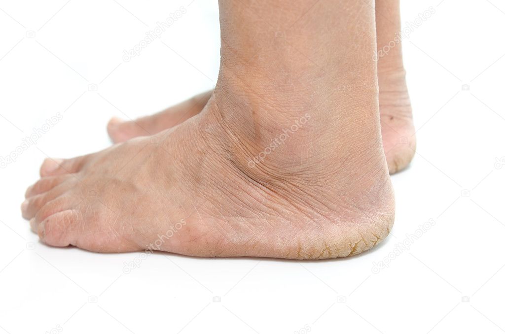 Закрывает пятку. Сквамозная эпидермофития. Закрывает пятку. Закрывает пятку. Мужские носки пятка.