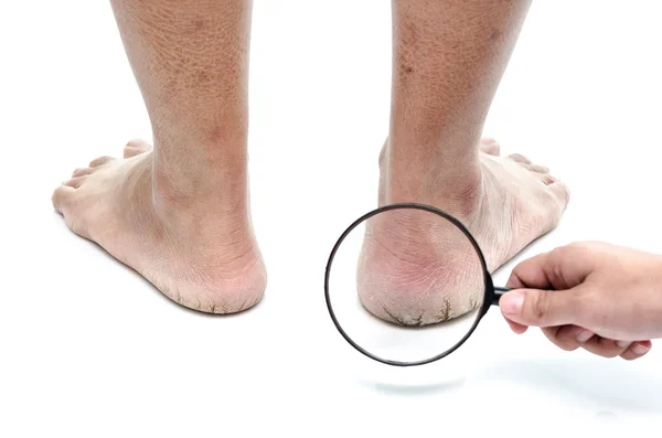 Close up of Cracks on Heels isolated — Stock Photo, Image