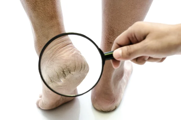 Close up of Cracks on Heels isolated — Stock Photo, Image