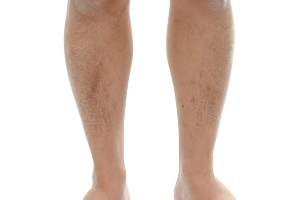 Closeup texture of  bad skin leg — Stock Photo, Image