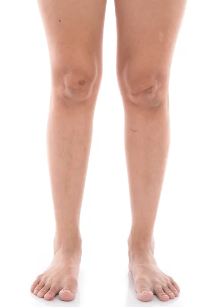 Close up scars on woman legs — Stock Photo, Image