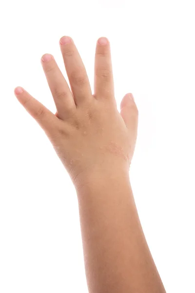 Eczema na mão do bebê — Fotografia de Stock
