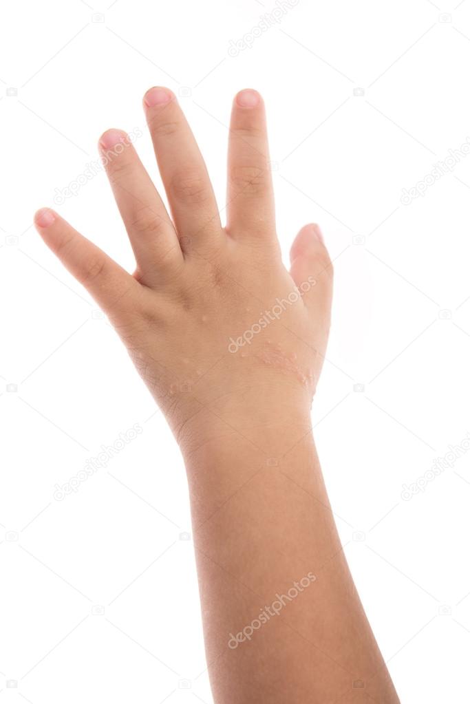 eczema on baby's hand