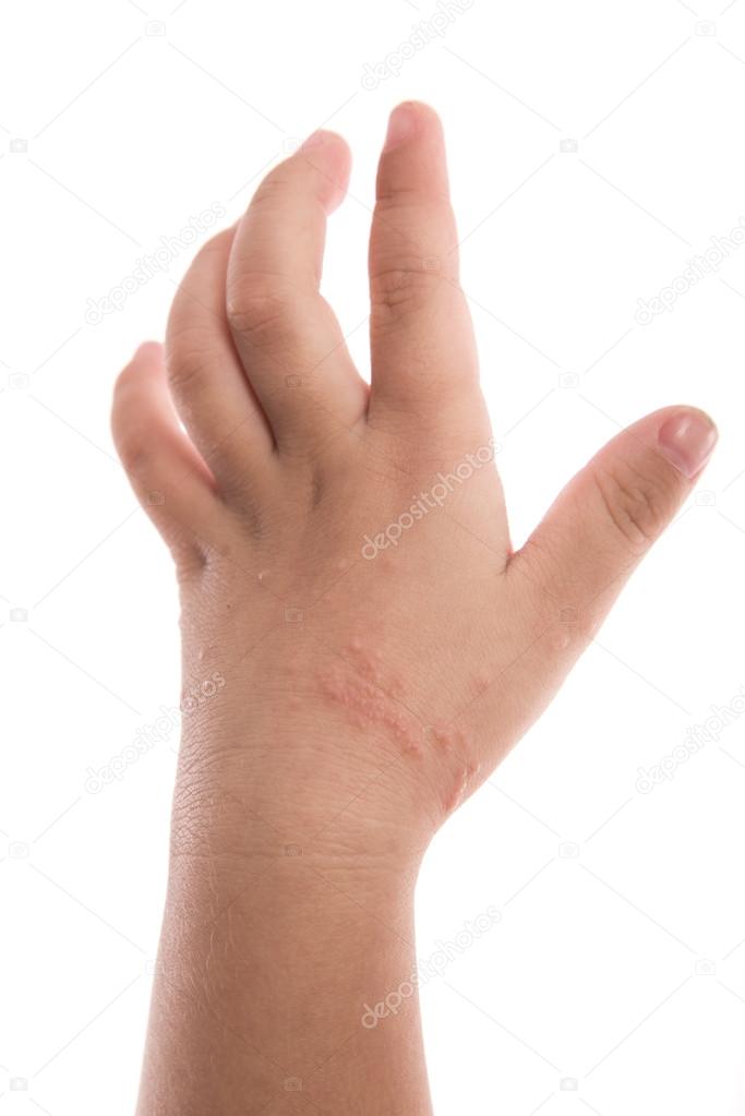 eczema on baby's hand