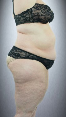 Kadın selülitini gösteriyor