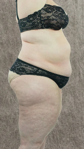 Frau zeigt ihre Cellulite — Stockfoto