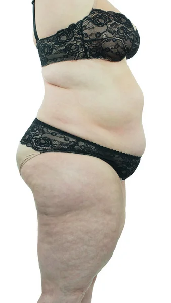 Woman showing her cellulite — Stock Photo, Image