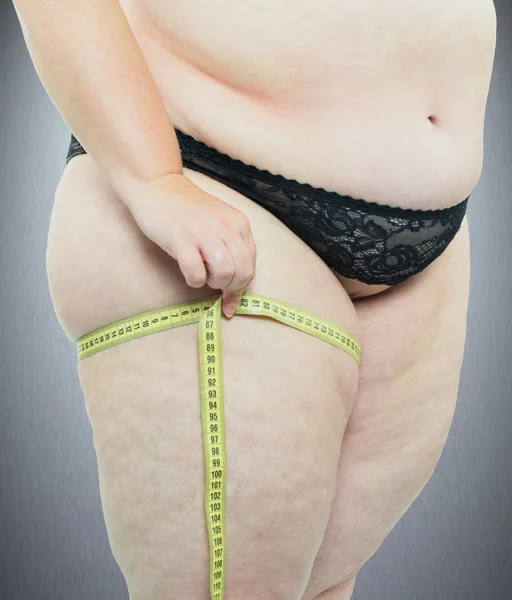 Vrouw toont haar cellulitis — Stockfoto