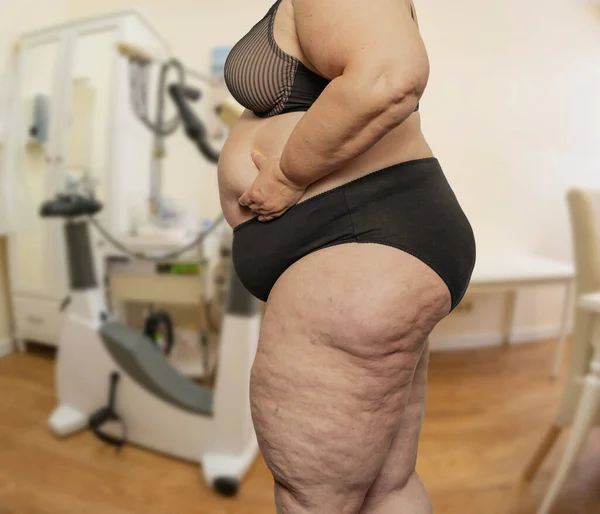 Woman with obesity and cellulite in a treatment room with a doctor