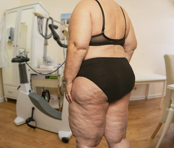 Donna Con Obesità Cellulite Una Sala Trattamento Con Medico — Foto Stock