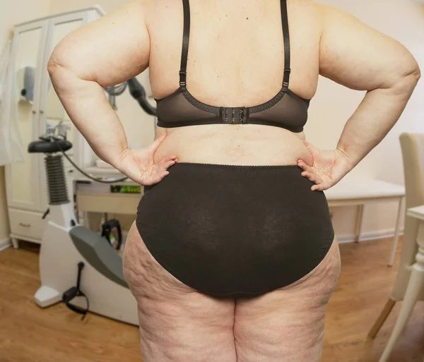 Donna Con Obesità Cellulite Una Sala Trattamento Con Medico — Foto Stock