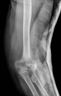 Röntgende kol ve dirsek kırılması