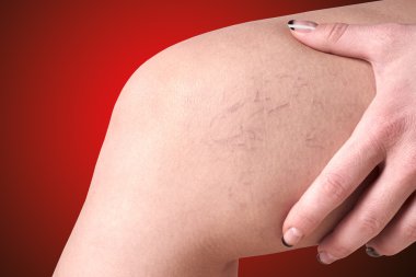 varicose veins in women clipart