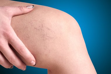 varicose veins in women clipart