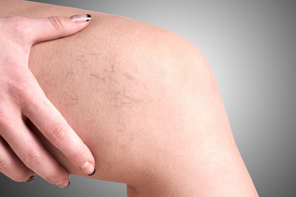 varicose veins in women