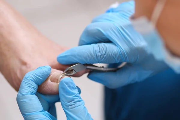 El médico extrae una infección de las uñas de los pies y la enfermedad, la inflamación. Clínica, instrumentos, estéril. — Foto de Stock