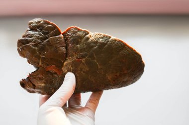  Doktorun elinde bir parça akciğer. Etkilenmiş organlar, sigara içen, tüberküloz, covid virüs. Hastalıklar, solunum hastalıklarının tedavisi.