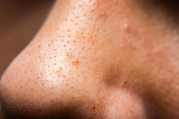 Closed-up of pimple blackheads on the nose of an european teenager, Enlarged pores on the face — Stock Photo, Image