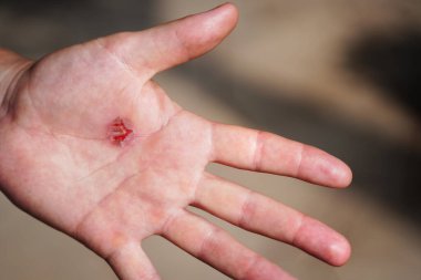 İnsan elinin nasırına yakın çekim, cilde yakından sürtünme. Cilt sorunları. Avuç içi nasırlı. Sıkı Çalışma Konsepti. Yaralı El 'de kabarcıklar. Yüksek kalite fotoğraf
