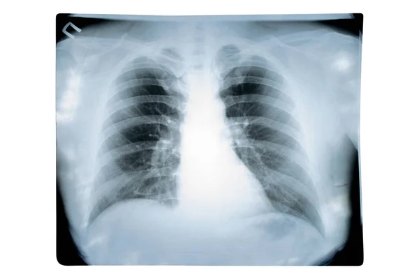 Chest x-ray checking the level of lung damage