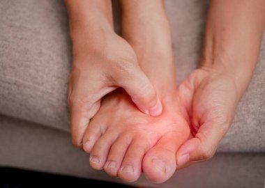 Acılı ayaklarını tutan ve acıyı dindirmek için ayak parmaklarına masaj yapan bir kadın. Baş parmağın kenarındaki şişmiş nasır deformasyona neden olur (Hallux valgus). Kadın sağlığı konsepti.