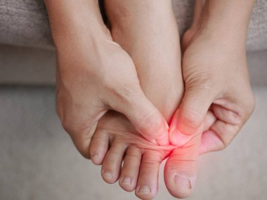 Acılı ayaklarını tutan ve acıyı dindirmek için ayak parmaklarına masaj yapan bir kadın. Baş parmağın kenarındaki şişmiş nasır deformasyona neden olur (Hallux valgus). Kadın sağlığı konsepti.