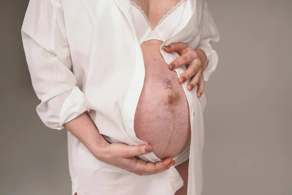 Stræk mærker på maven af en gravid kvinde. Pigen venter et barn. Gravid ung mor holder maven - Stock-foto