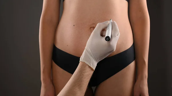 Nahaufnahme Des Weiblichen Bauches Der Für Plastische Chirurgie Markiert Ist — Stockfoto