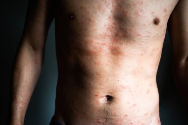 Deri kusuru. Cilt alerjisi olan çıplak bir adam. Ürtiker hastalığı. Cildinde kırmızı lekeler var. Yakın plan..