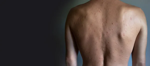 皮肤不完美裸男皮肤过敏 荨麻疹病 皮肤上的红斑四 后续行动 — 图库照片