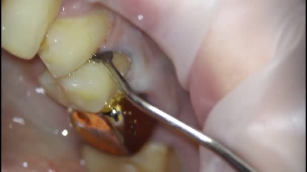 Tandheelkunde. schieten met een microscoop. tandheelkundige behandeling. installatie van een intrekdraad om het tandvlees te beschermen tegen beschadiging — Stockvideo