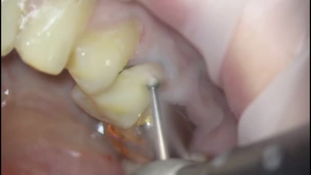 Dentistry. removal of old fillings and treatment of damaged tooth tissues — Stock Video
