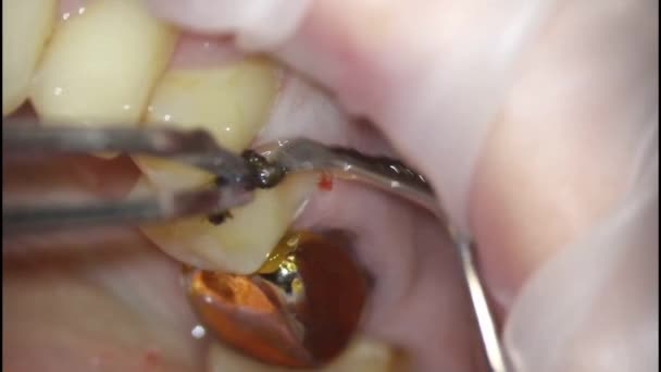 Odontologia. tiro com um microscópio. tratamento dentário. instalação de um fio de retração para proteger as gengivas de danos — Vídeo de Stock