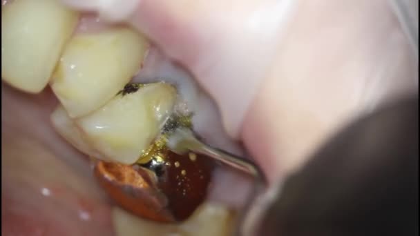 Zahnmedizin. Aufnahmen mit dem Mikroskop. Zahnbehandlung. Einbau eines Einziehgewindes zum Schutz des Zahnfleisches vor Beschädigung — Stockvideo