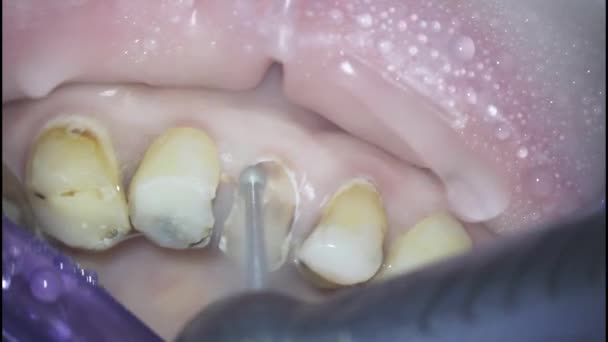 Odontología. disparando con un microscopio. tratamiento dental de un defecto dental en forma de cuña. extracción de tejido dental muerto con un taladro — Vídeo de stock