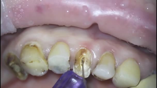 Dentistry. shooting with a microscope. dental treatment. mechanical expansion of the root canal with an endomotor with a root file — Stock Video
