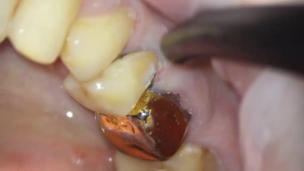 牙科学 用显微镜拍摄 牙科治疗 用压缩空气吹干生病的牙齿 然后取出旧的填充物 — 图库视频影像