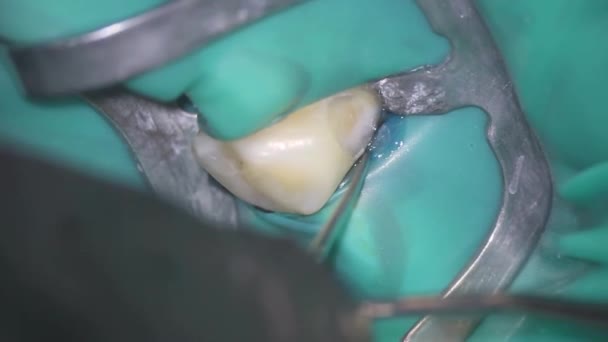 Odontología Disparando Con Microscopio Tratamiento Dental Utilizando Una Lámpara Fotopolímero — Vídeo de stock