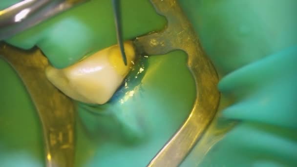 Odontologia Tiro Com Microscópio Tratamento Dentário Alinhamento Com Gancho Dental — Vídeo de Stock