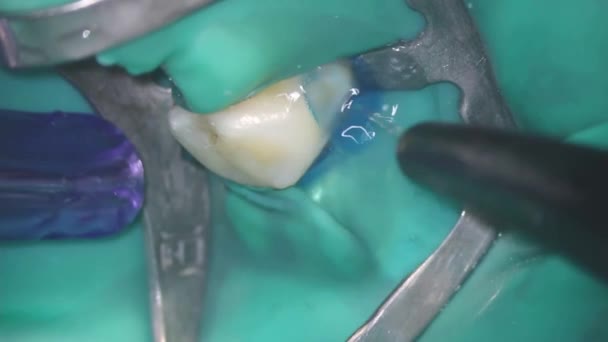 Zahnmedizin. Aufnahmen mit dem Mikroskop. Zahnbehandlung. Entfernen des Ätzgels vom erkrankten Zahn mit einer Lösung aus der Spritze, bevor die Füllung eingebaut wird. Sargdamm