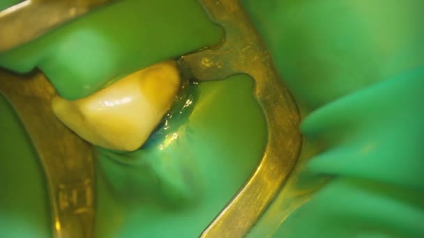Dokter Gigi Menembak Dengan Mikroskop Pengobatan Gigi Menggunakan Lampu Photopolymer — Stok Video