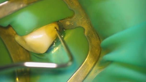 Odontologia Tiro Com Microscópio Tratamento Dentário Alinhamento Com Gancho Dental — Vídeo de Stock