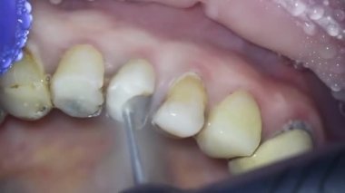 Dişçilik. Mikroskop ile ateş etmek. Nekrektomi. Diş hekimi eski dolguyu özel aletlerle çıkarır ve hasarlı diş dokularını sökerek işleme tabi tutar.