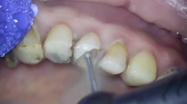 Dişçilik. Mikroskop ile ateş etmek. Nekrektomi. Diş hekimi eski dolguyu özel aletlerle çıkarır ve hasarlı diş dokularını sökerek işleme tabi tutar.