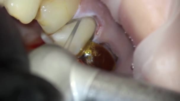 Odontologia Tiro Com Microscópio Tratamento Dentário Prevenção Remoção Mecânica Placa — Vídeo de Stock