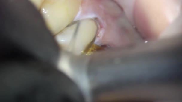 Zubařství Mikroskopem Zubní Ošetření Prevence Mechanické Odstranění Zubního Plaku Horních — Stock video