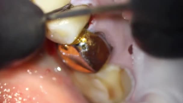 Odontologia Tiro Com Microscópio Tratamento Dentário Extração Fio Retração Com — Vídeo de Stock