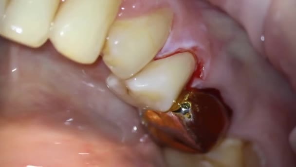 Dişçilik Mikroskop Ile Ateş Etmek Ağız Boşluğunun Incelenmesi Ameliyattan Sonra — Stok video