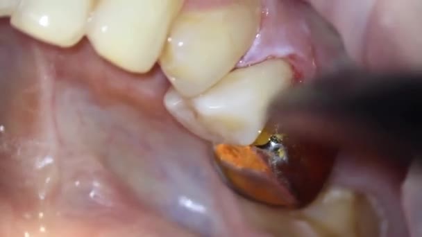 치과의 현미경으로 위턱의 근처에 흘리는 상처를 살균제로 거울을 사용하여 검사하였다 — 비디오