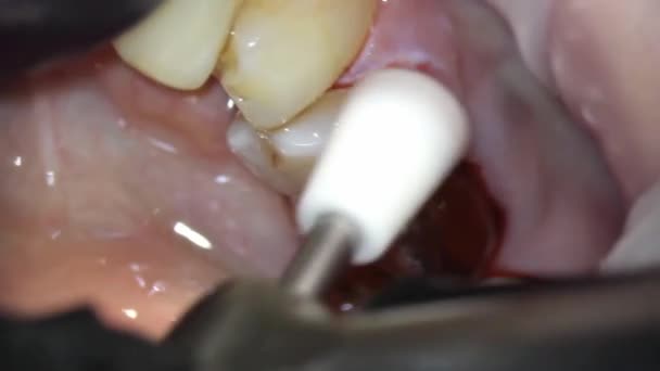 Odontología Imagen Del Microscopio Tratamiento Dental Pulido Final Del Relleno — Vídeo de stock